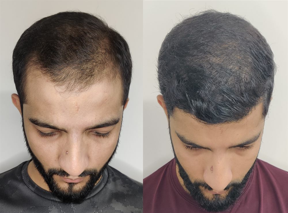 Advanced baldness hair restoration patient result