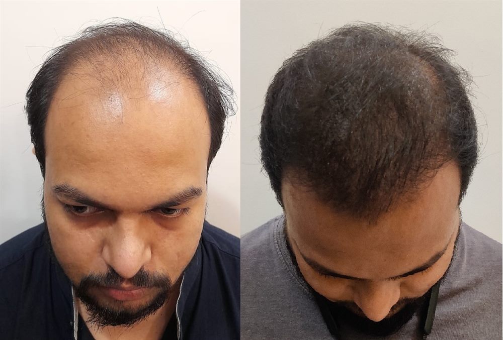 Hair restoration patient result crown and scalp density