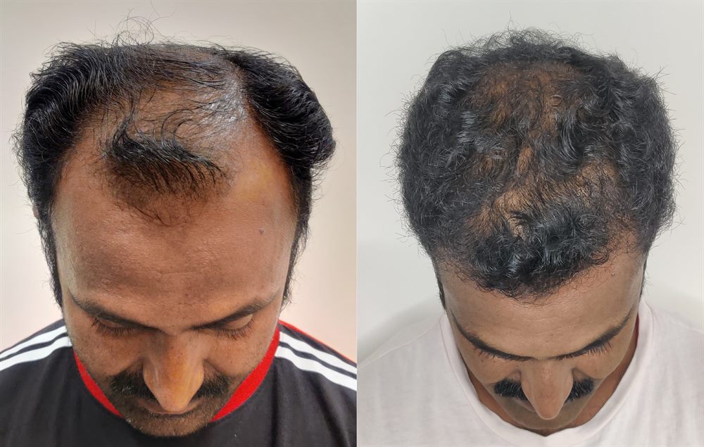 Hair transplant result after advanced scalp restoration