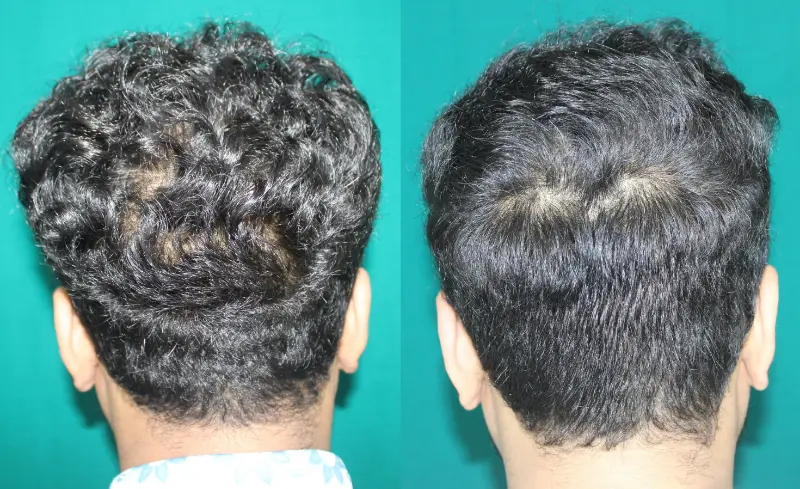 Chaityana Desai hair transplant result