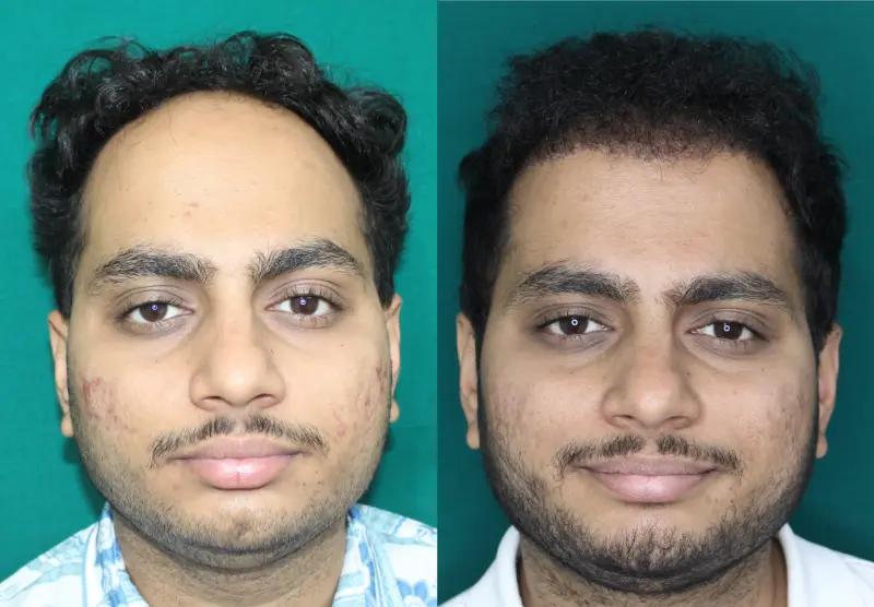 Chaityana Desai hair transplant before and after result 2