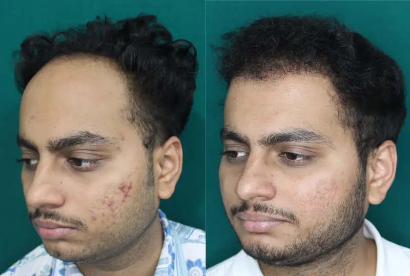 Chaityana Desai hair transplant before and after result 5