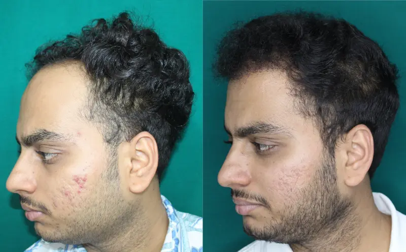 Chaityana Desai hair transplant before and after result 6