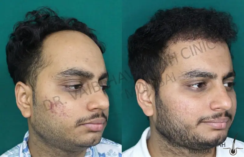 Chaityana Desai hair transplant before and after result 7