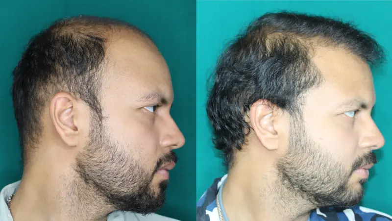 Pt Rushabh Singh hair transplant result 3