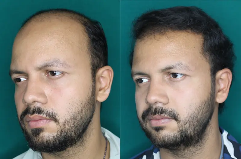 Pt Rushabh Singh hair transplant result 4