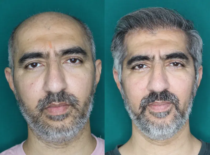 Pt Abhishek hair transplant result 3