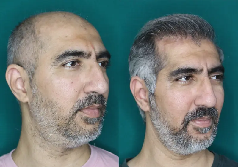 Pt Abhishek hair transplant result 4
