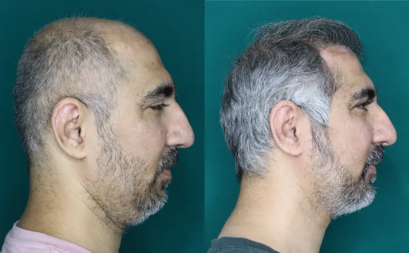Pt Abhishek hair transplant result 6
