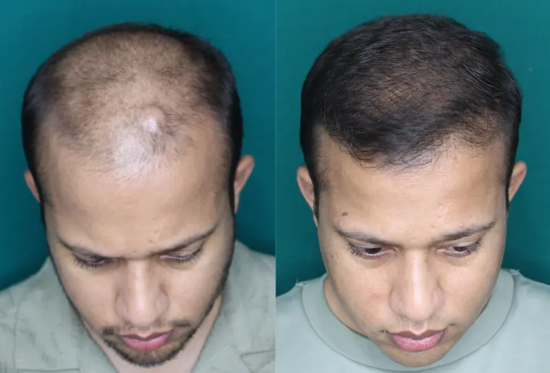 Pt Dharshan Vira hair transplant result