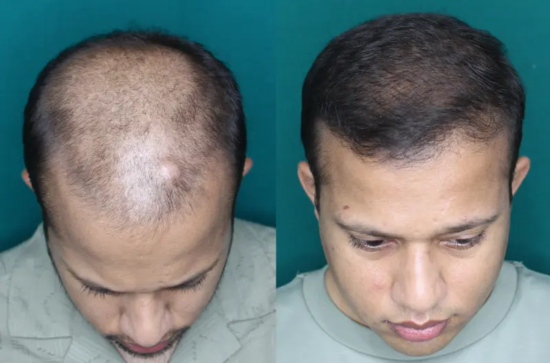 Pt Dharshan Vira hair transplant result 2