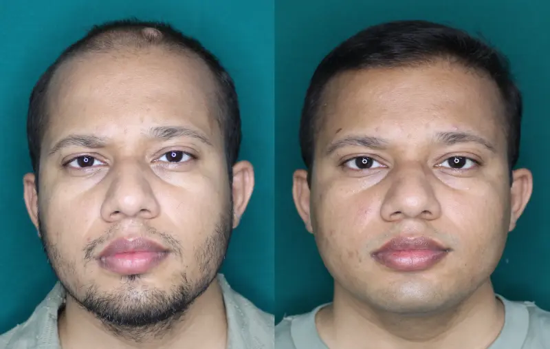 Pt Dharshan Vira hair transplant result 3