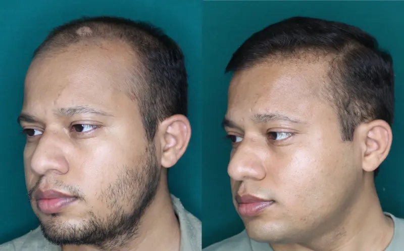 Pt Dharshan Vira hair transplant result 6