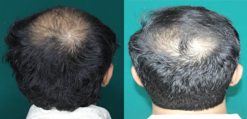 Pt Dherya Nathwani hair transplant result 2