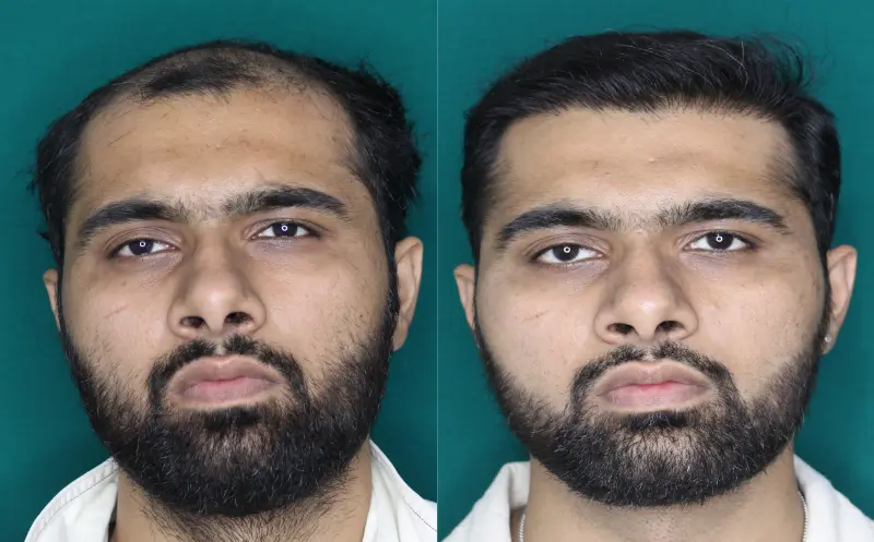 Pt Dherya Nathwani hair transplant result 3