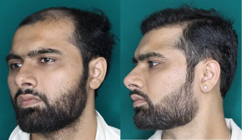 Pt Dherya Nathwani hair transplant result 6