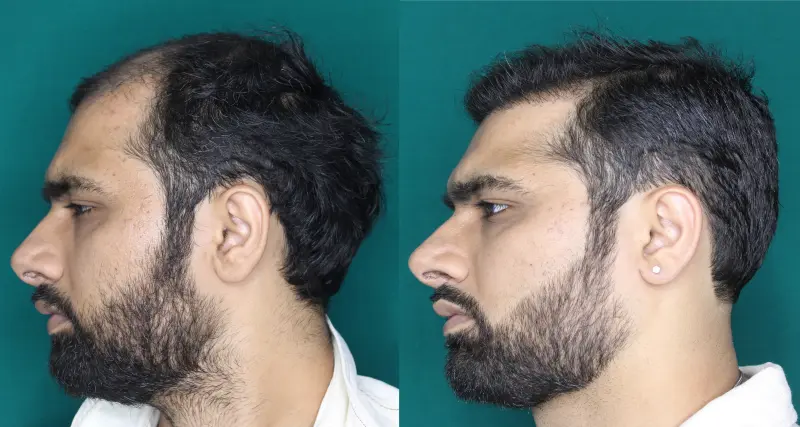 Pt Dherya Nathwani hair transplant result 7