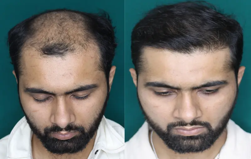Pt Dherya Nathwani hair transplant result 8