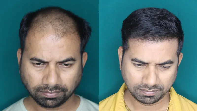 Pt Jagdish Ghar hair transplant result