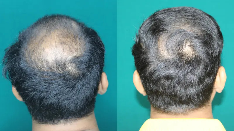 Pt Jagdish Ghar hair transplant result 2