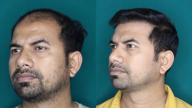 Pt Jagdish Ghar hair transplant result 6