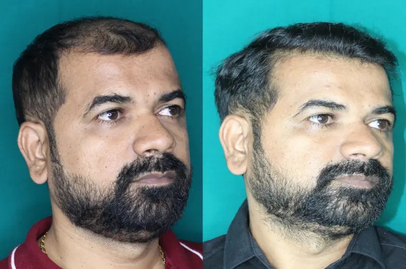 Pt Praful Gole hair transplant result 4