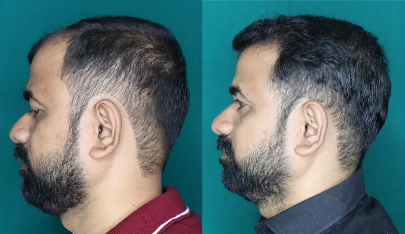 Pt Praful Gole hair transplant result 7