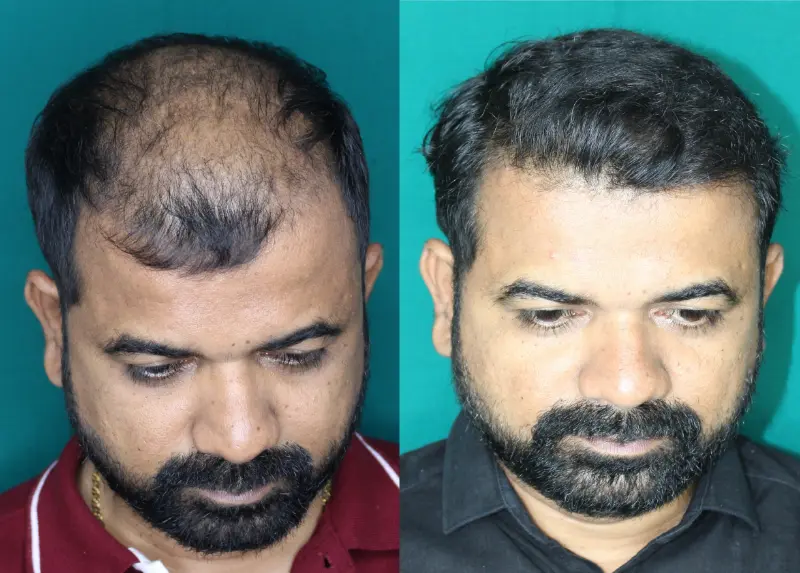 Pt Praful Gole hair transplant result 8