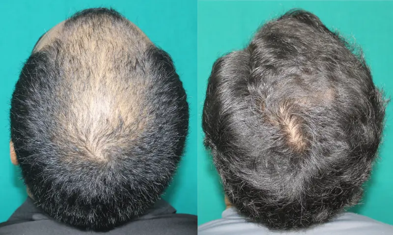 Pt Yohan hair transplant result 2