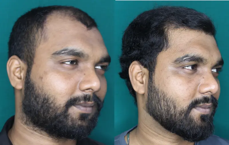 Pt Yohan hair transplant result 4