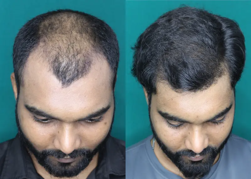 Pt Yohan hair transplant result 8
