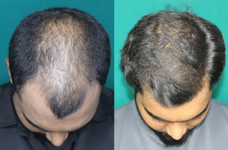 Pt Yohan hair transplant result 9